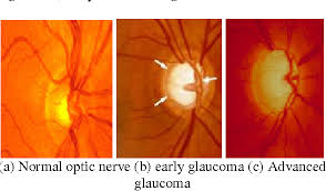 Glaucoma Detection