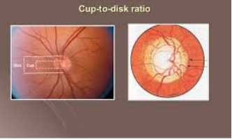 Glaucoma Detection