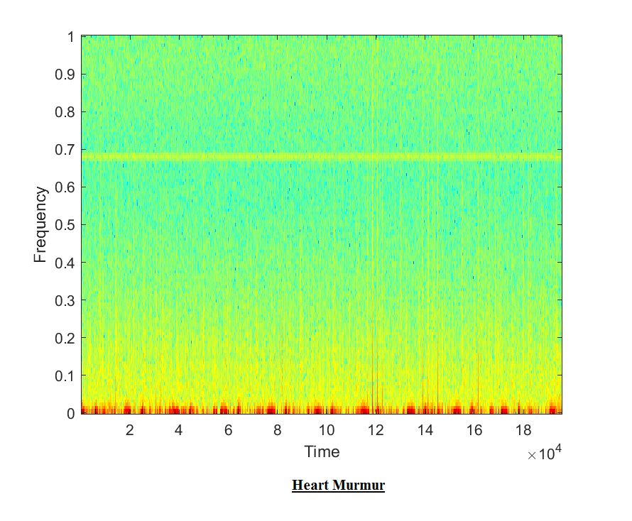 Heart Sound detection